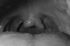 Úvula bífida en cavidad oral con superficie palatina aparentemente normal